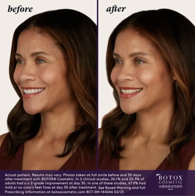 Before & After | Botox | DeFuniak All-Care Walk-in Clinic