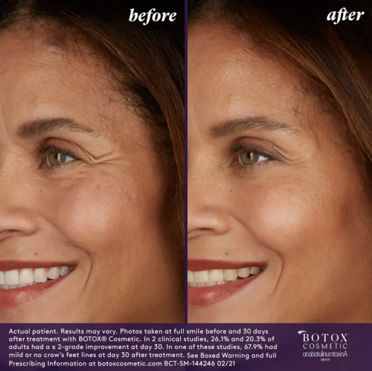 Before & After | Botox | DeFuniak All-Care Walk-in Clinic